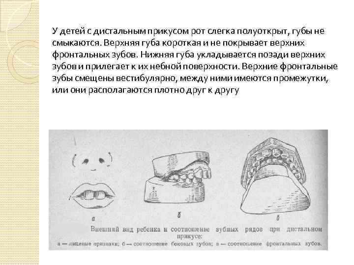 У детей с дистальным прикусом рот слегка полуоткрыт, губы не смыкаются. Верхняя губа короткая