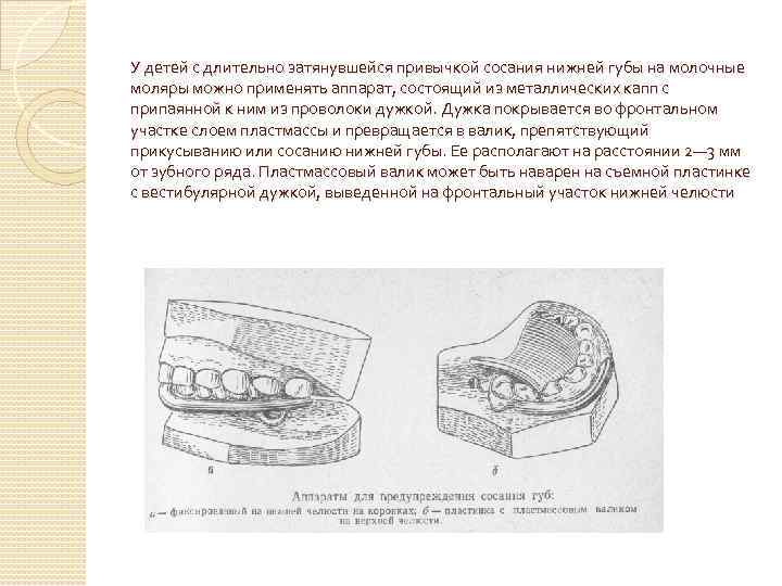 У детей с длительно затянувшейся привычкой сосания нижней губы на молочные моляры можно применять