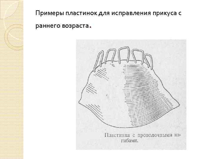 Примеры пластинок для исправления прикуса с . раннего возраста 