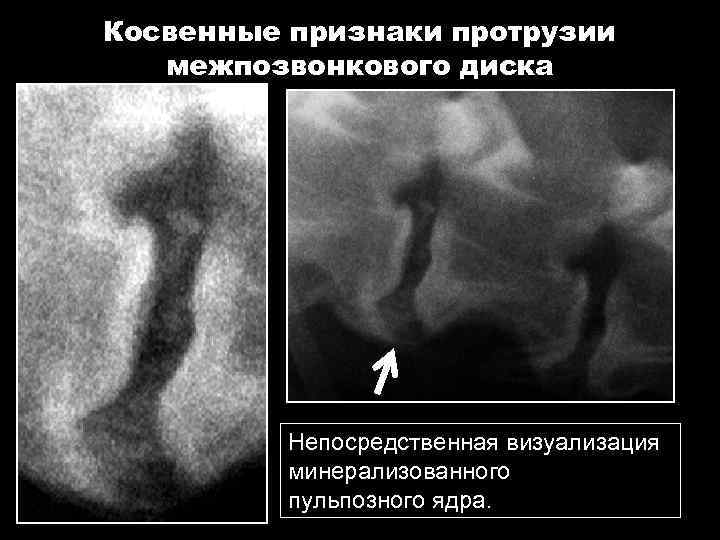 Косвенные признаки протрузии межпозвонкового диска Непосредственная визуализация минерализованного пульпозного ядра. 