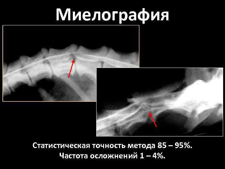 Миелография Статистическая точность метода 85 – 95%. Частота осложнений 1 – 4%. 