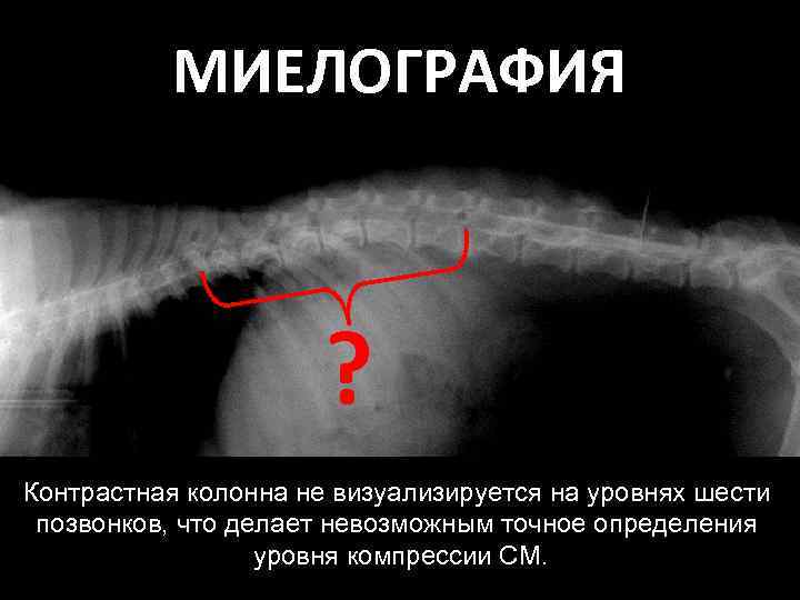 МИЕЛОГРАФИЯ ? Контрастная колонна не визуализируется на уровнях шести позвонков, что делает невозможным точное