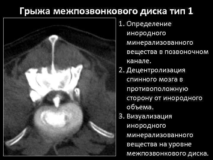 Грыжа межпозвонкового диска тип 1 1. Определение инородного минерализованного вещества в позвоночном канале. 2.