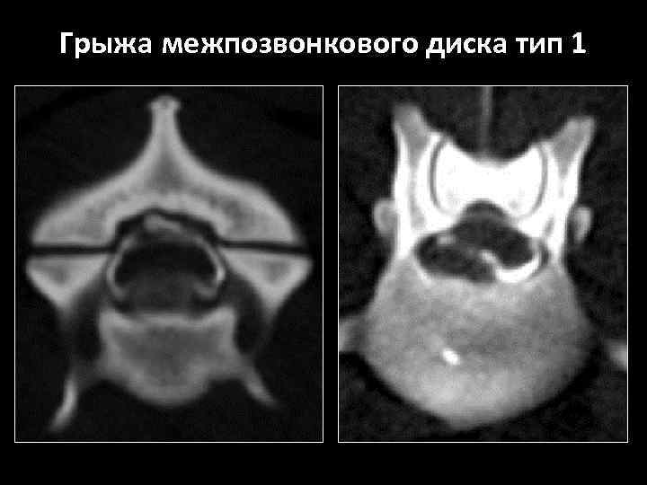 Грыжа межпозвонкового диска тип 1 