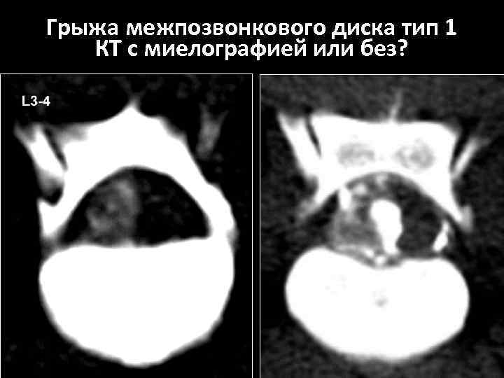 Грыжа межпозвонкового диска тип 1 КТ с миелографией или без? 