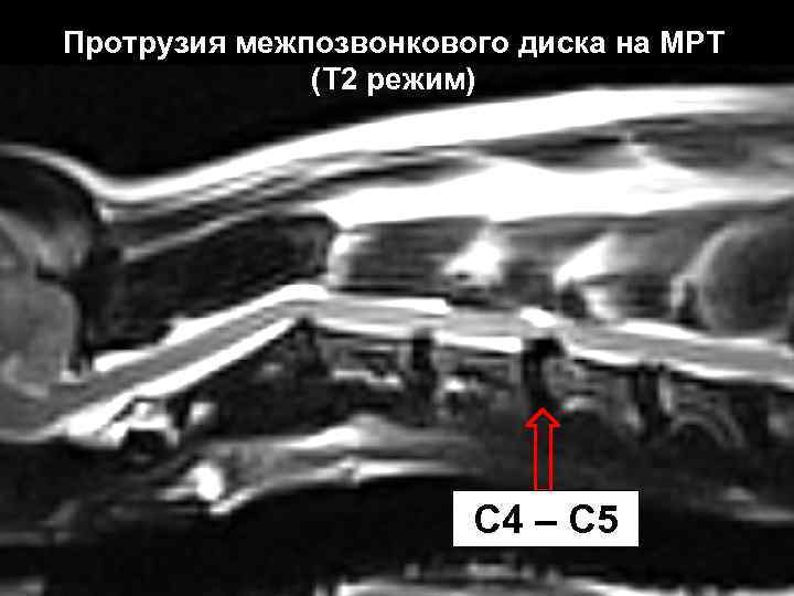 Протрузия межпозвонкового диска на МРТ (Т 2 режим) C 4 – C 5 