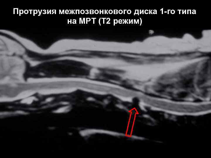 Протрузия межпозвонкового диска 1 -го типа на МРТ (Т 2 режим) 