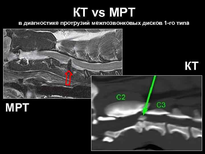 КТ vs МРТ в диагностике протрузий межпозвонковых дисков 1 -го типа КТ МРТ 