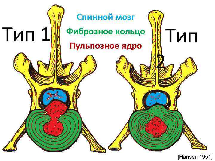 Тип 1 Спинной мозг Фиброзное кольцо Пульпозное ядро Тип 2 [Hansen 1951] 
