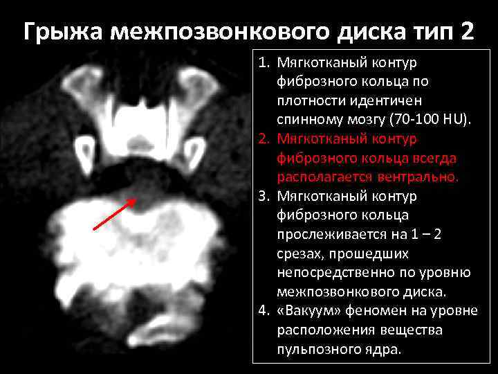 Грыжа межпозвонкового диска тип 2 1. Мягкотканый контур фиброзного кольца по плотности идентичен спинному