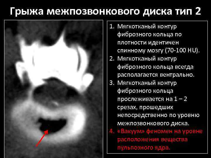 Грыжа межпозвонкового диска тип 2 1. Мягкотканый контур фиброзного кольца по плотности идентичен спинному