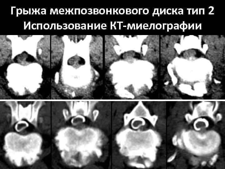 Грыжа межпозвонкового диска тип 2 Использование КТ-миелографии 