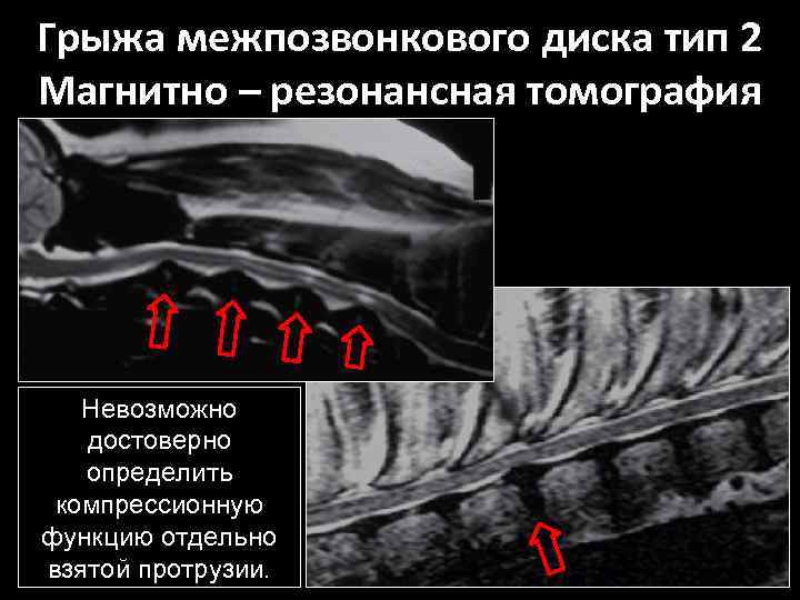 Грыжа межпозвонкового диска тип 2 Магнитно – резонансная томография Невозможно достоверно определить компрессионную функцию