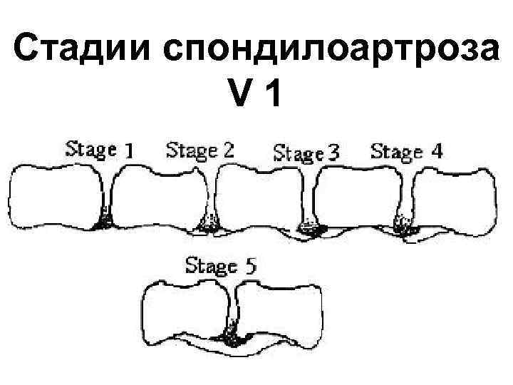 Стадии спондилоартроза V 1 