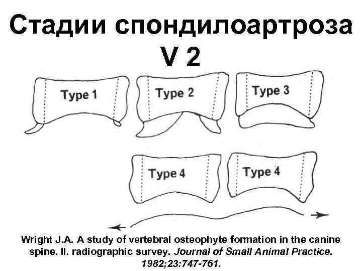 Стадии спондилоартроза V 2 Wright J. A. A study of vertebral osteophyte formation in