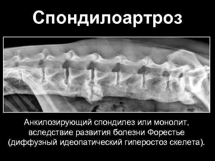 Спондилез что это. Анкилозирующий спондилез. Анкилозирующий спондилез поясничного отдела позвоночника. Анкилозирующий спондилоартроз. Спондилез спондилоартроз.