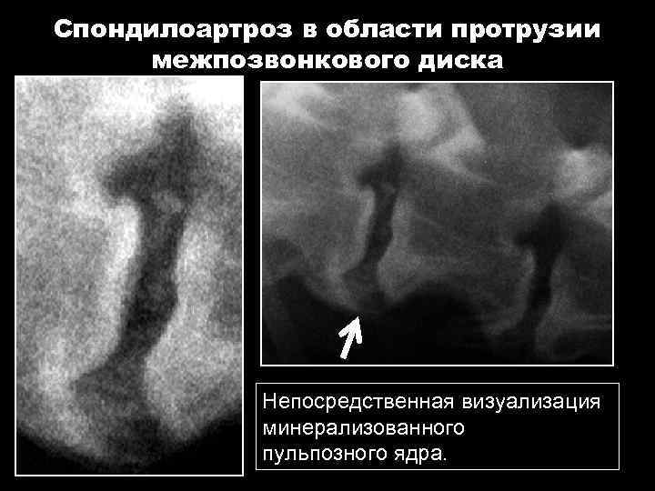 Спондилоартроз в области протрузии межпозвонкового диска Непосредственная визуализация минерализованного пульпозного ядра. 