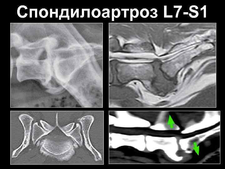 Спондилоартроз L 7 -S 1 