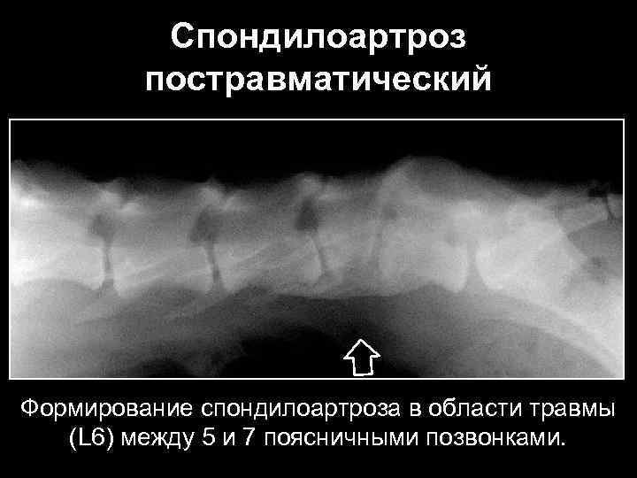 Спондилоартроз постравматический Формирование спондилоартроза в области травмы (L 6) между 5 и 7 поясничными