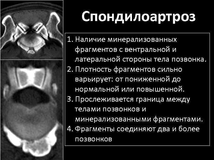 Спондилоартроз. Спондилоартроз кт. Спондилоартроз мрт. Спондилоартроз степени.