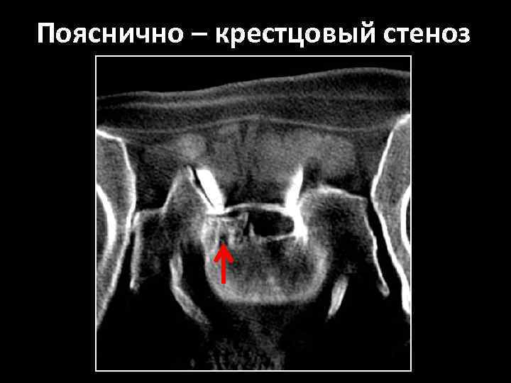 Пояснично – крестцовый стеноз 