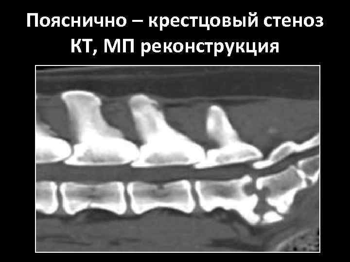 Пояснично – крестцовый стеноз КТ, МП реконструкция 