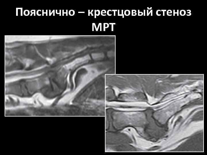 Пояснично – крестцовый стеноз МРТ 