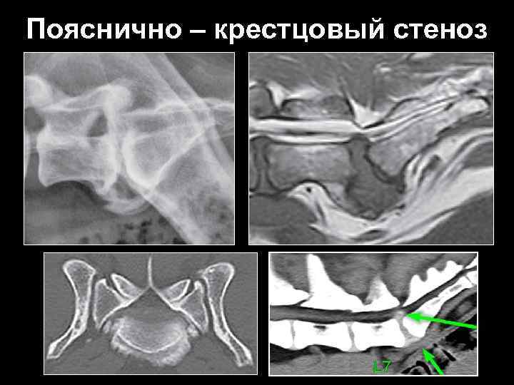 Пояснично – крестцовый стеноз 