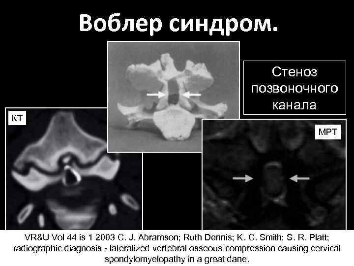 Воблер синдром. Стеноз позвоночного канала КТ МРТ VR&U Vol 44 is 1 2003 C.