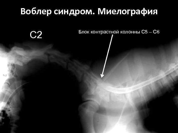 Воблер синдром. Миелография С 2 Блок контрастной колонны С 5 – С 6 