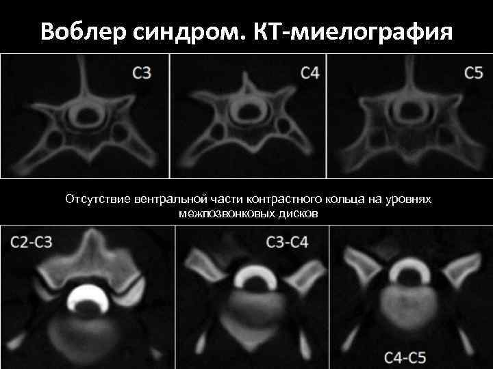 Воблер синдром. КТ-миелография Отсутствие вентральной части контрастного кольца на уровнях межпозвонковых дисков 