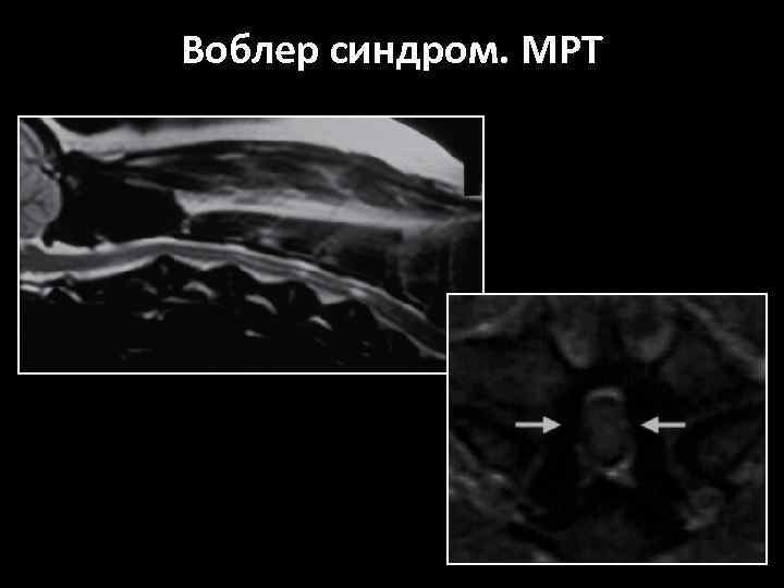 Воблер синдром. МРТ 