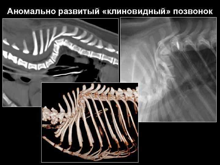 Аномально развитый «клиновидный» позвонок 