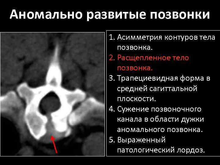 Аномально развитые позвонки 1. Асимметрия контуров тела позвонка. 2. Расщепленное тело позвонка. 3. Трапециевидная