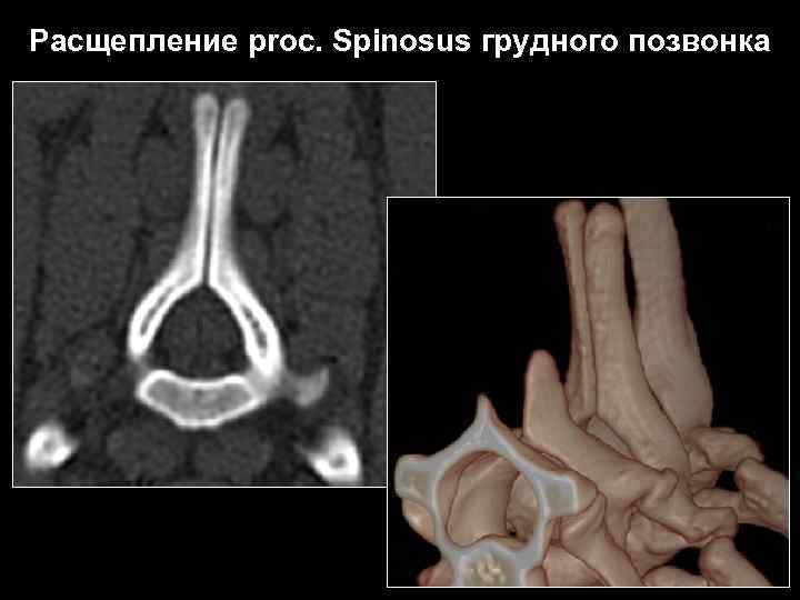 Расщепление proc. Spinosus грудного позвонка 