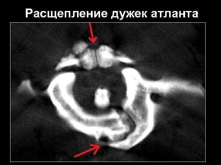 Расщепление дужек атланта 