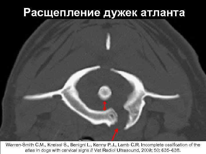 Расщепление дужек атланта Warren-Smith C. M. , Kneissl S. , Benigni L. , Kenny