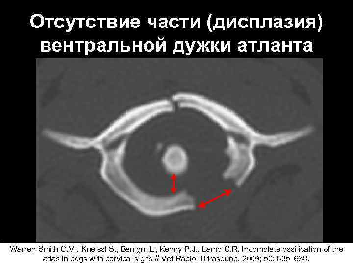 Отсутствие части (дисплазия) вентральной дужки атланта Warren-Smith C. M. , Kneissl S. , Benigni