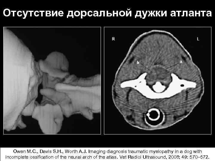 Отсутствие дорсальной дужки атланта Owen M. C. , Davis S. H. , Worth A.