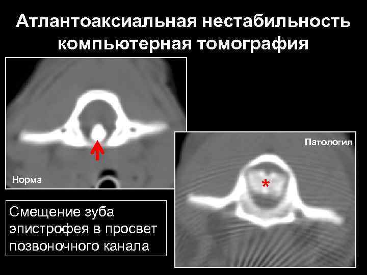 Атлантоаксиальная нестабильность компьютерная томография Патология Норма Смещение зуба эпистрофея в просвет позвоночного канала *