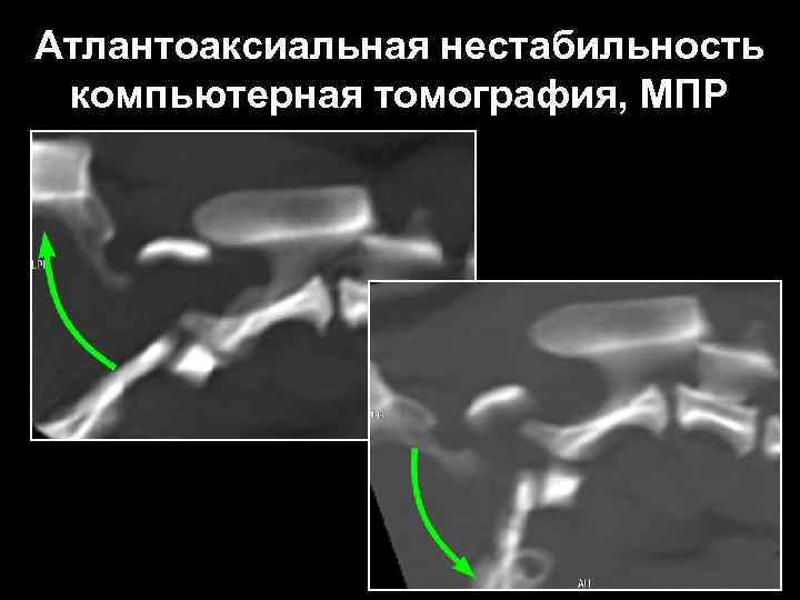 Атлантоаксиальная нестабильность компьютерная томография, МПР 