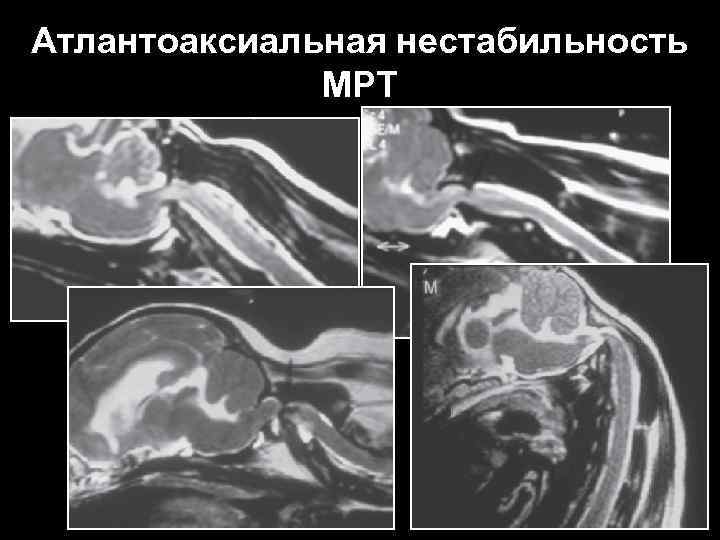 Атлантоаксиальная нестабильность МРТ 