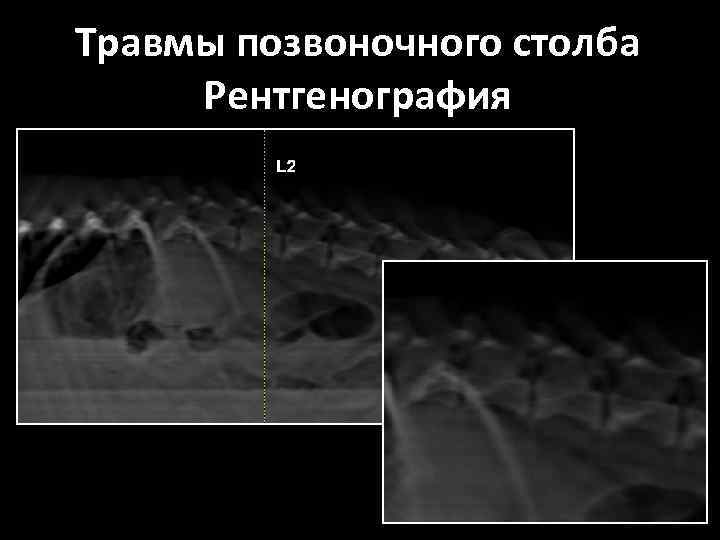 Травмы позвоночного столба Рентгенография 