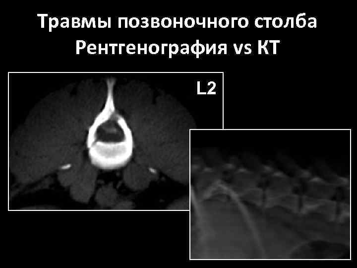 Травмы позвоночного столба Рентгенография vs КТ L 2 