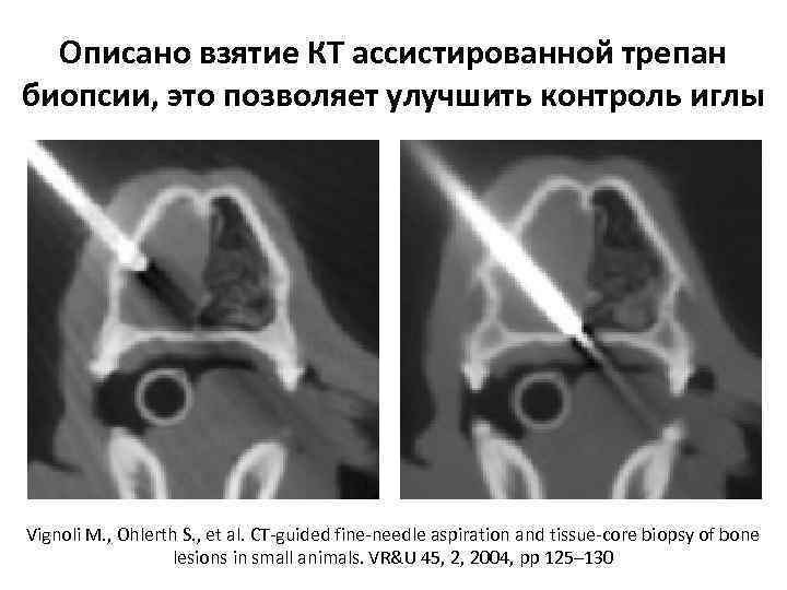 Описано взятие КТ ассистированной трепан биопсии, это позволяет улучшить контроль иглы Vignoli M. ,