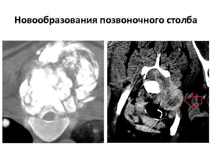 Новообразования позвоночного столба 