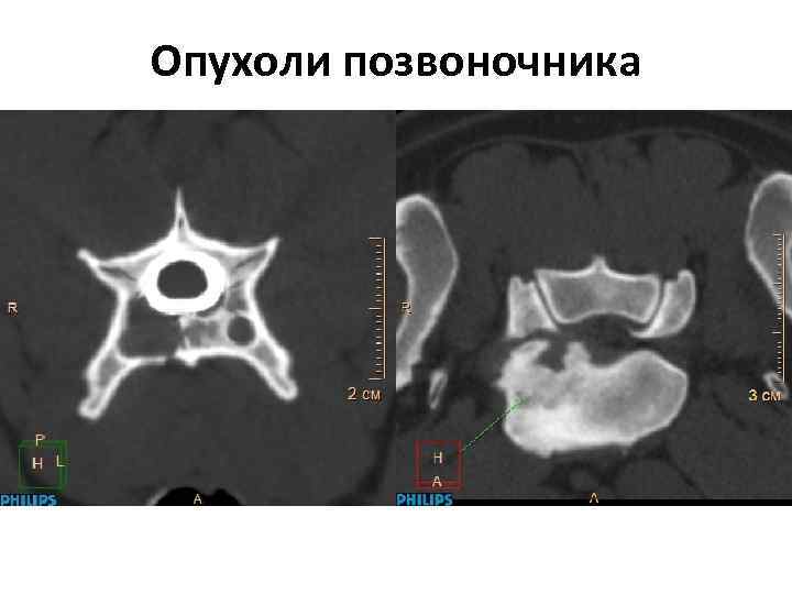 Опухоли позвоночника 