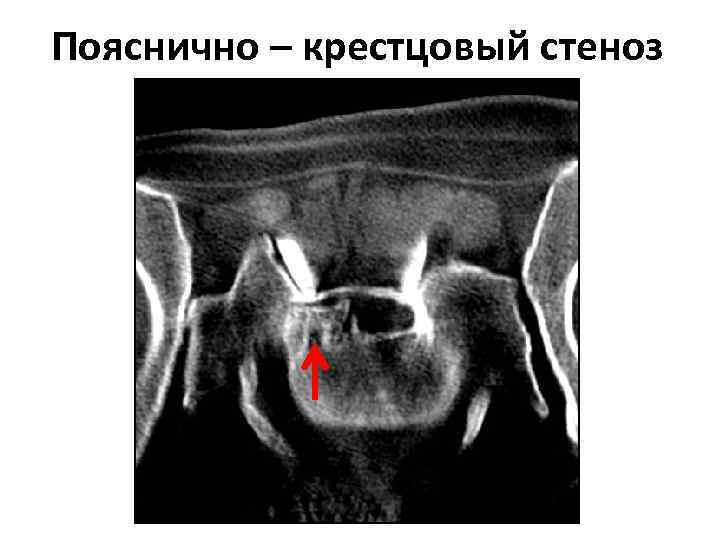 Пояснично – крестцовый стеноз 