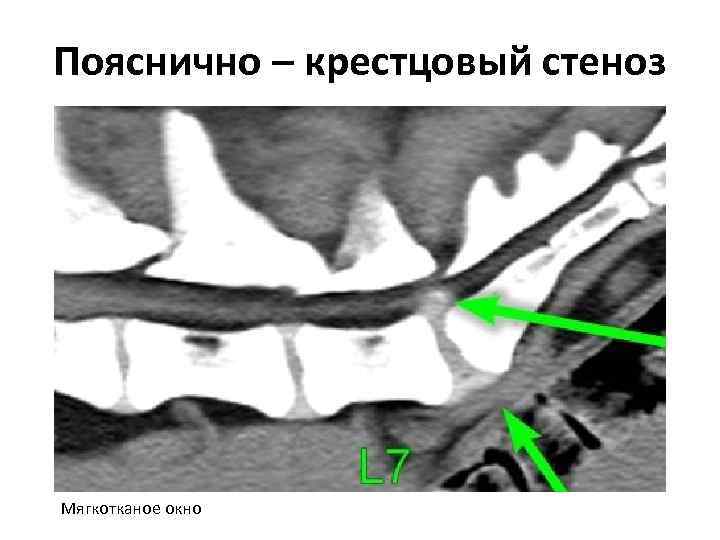 Пояснично – крестцовый стеноз Мягкотканое окно 