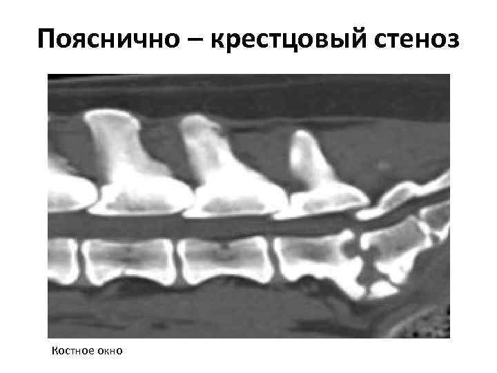 Пояснично – крестцовый стеноз Костное окно 